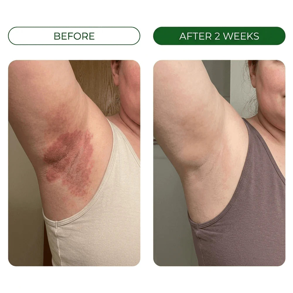 Burning Stops Day One.  Rash Clears In Days.  Smell Eliminated.