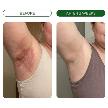 Burning Stops Day One.  Rash Clears In Days.  Smell Eliminated.