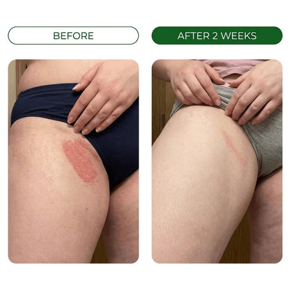 Burning Stops Day One.  Rash Clears In Days.  Smell Eliminated.