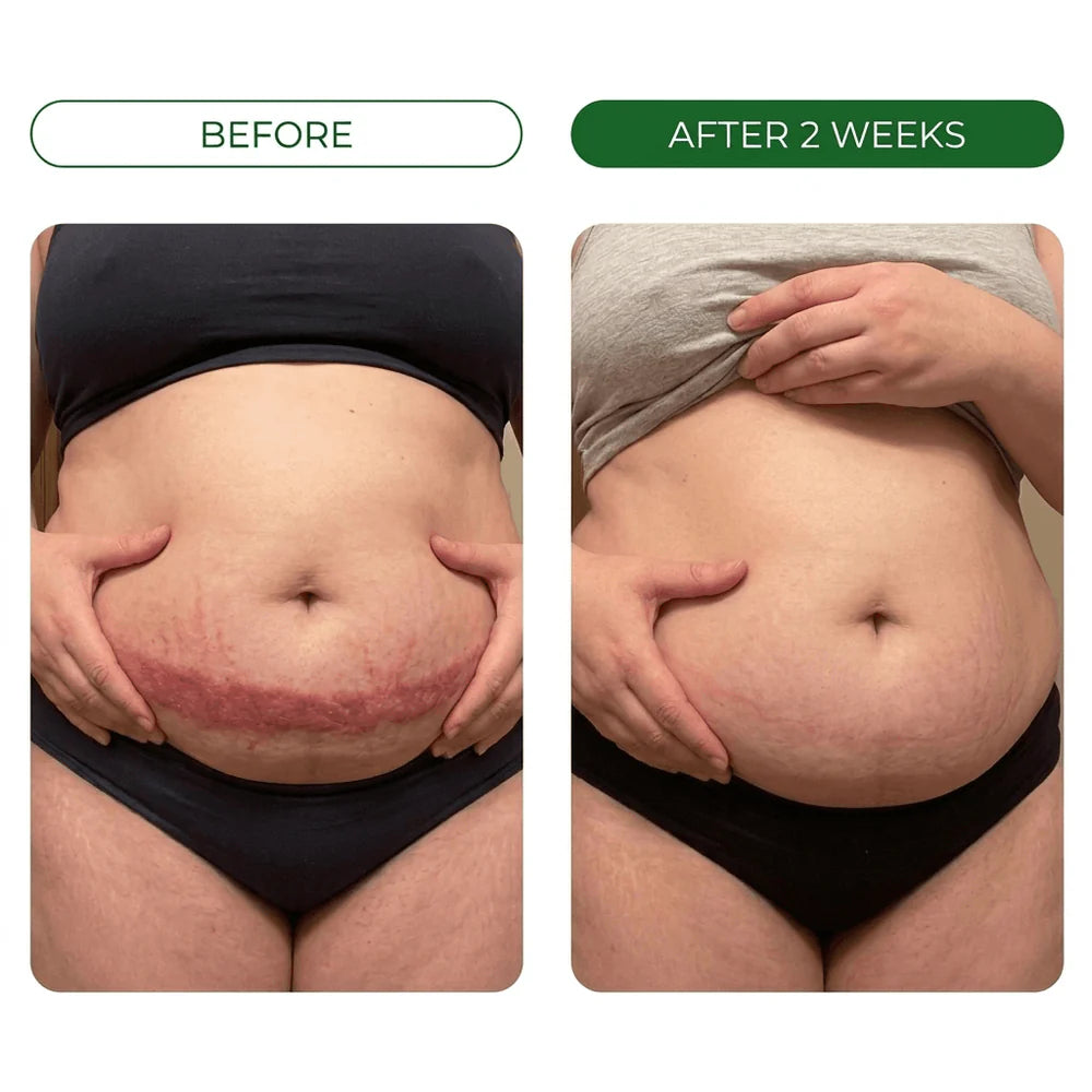 Burning Stops Day One.  Rash Clears In Days.  Smell Eliminated.